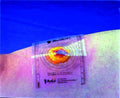 Wound Measuring Guide K224